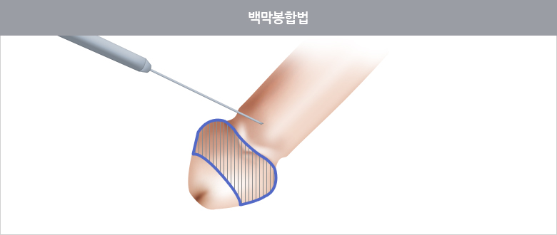 백막봉합법