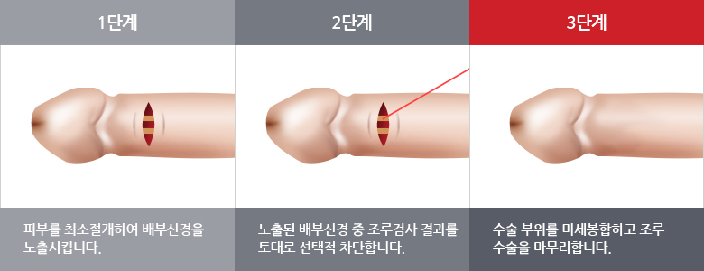 음경배부신경차단술 수술단계