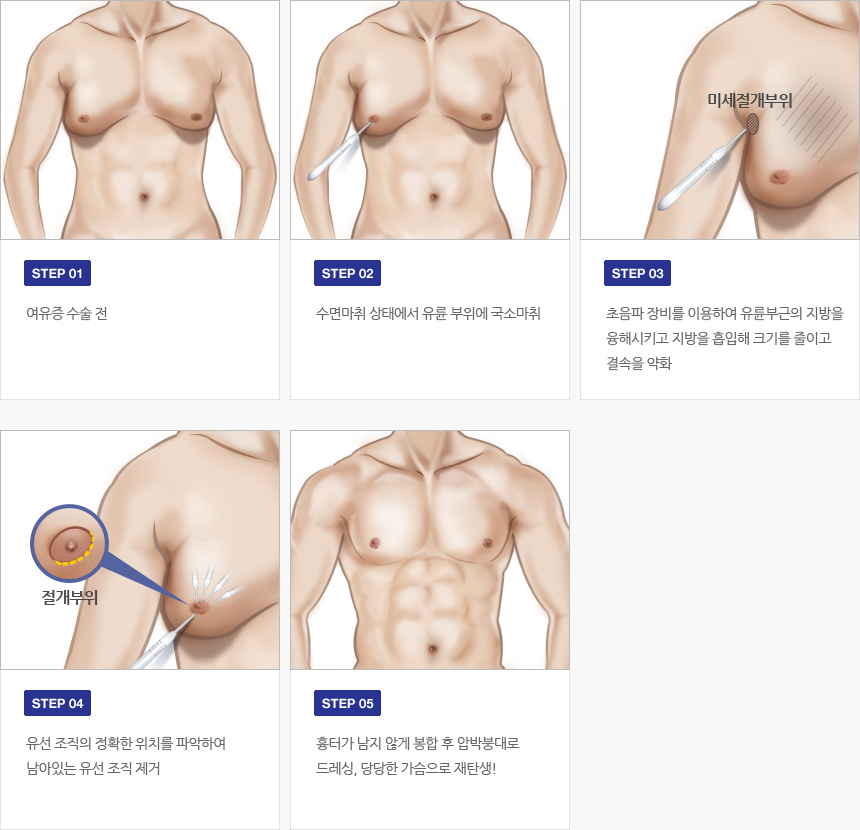 여유증 치료 방법