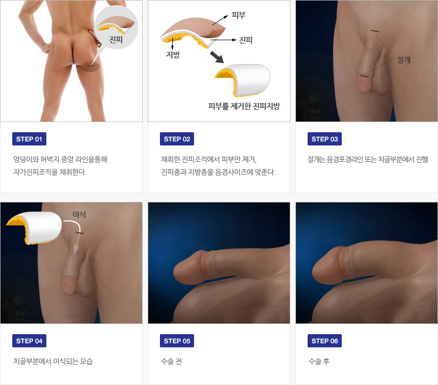 자가진피 수술과정