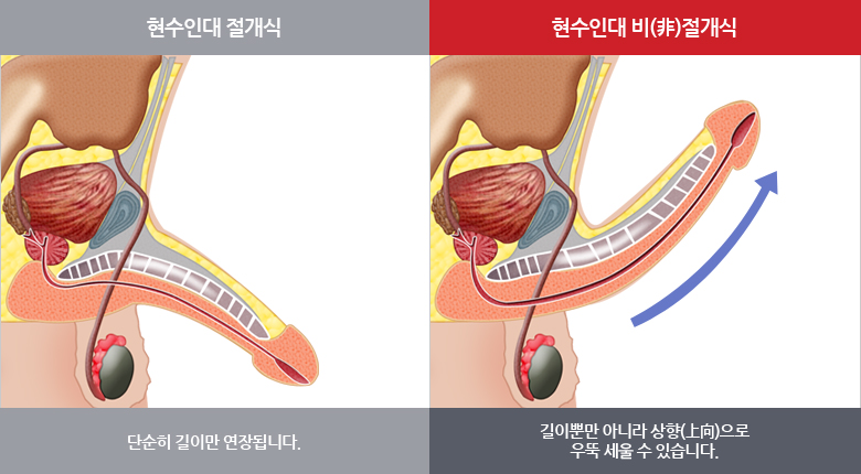 리드엠의 현수인대 비절개식 길이연장