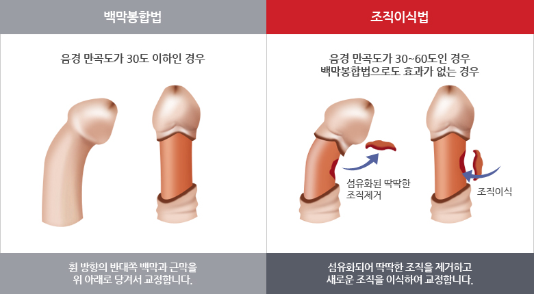 음경만곡증의 치료