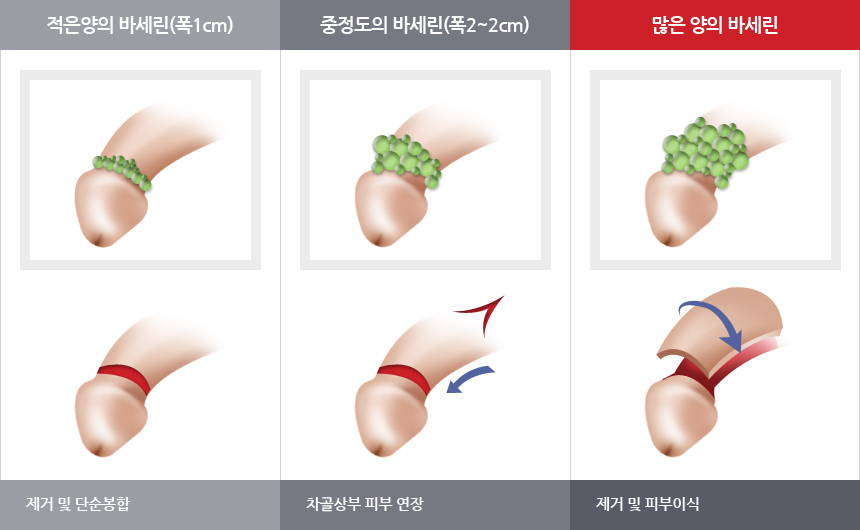 바세린 제거