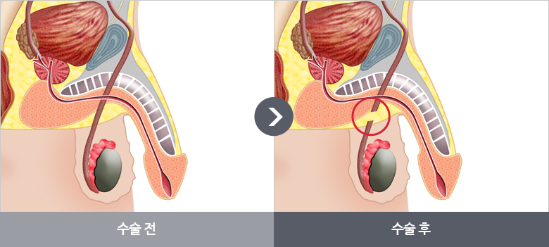 정관수술 과정